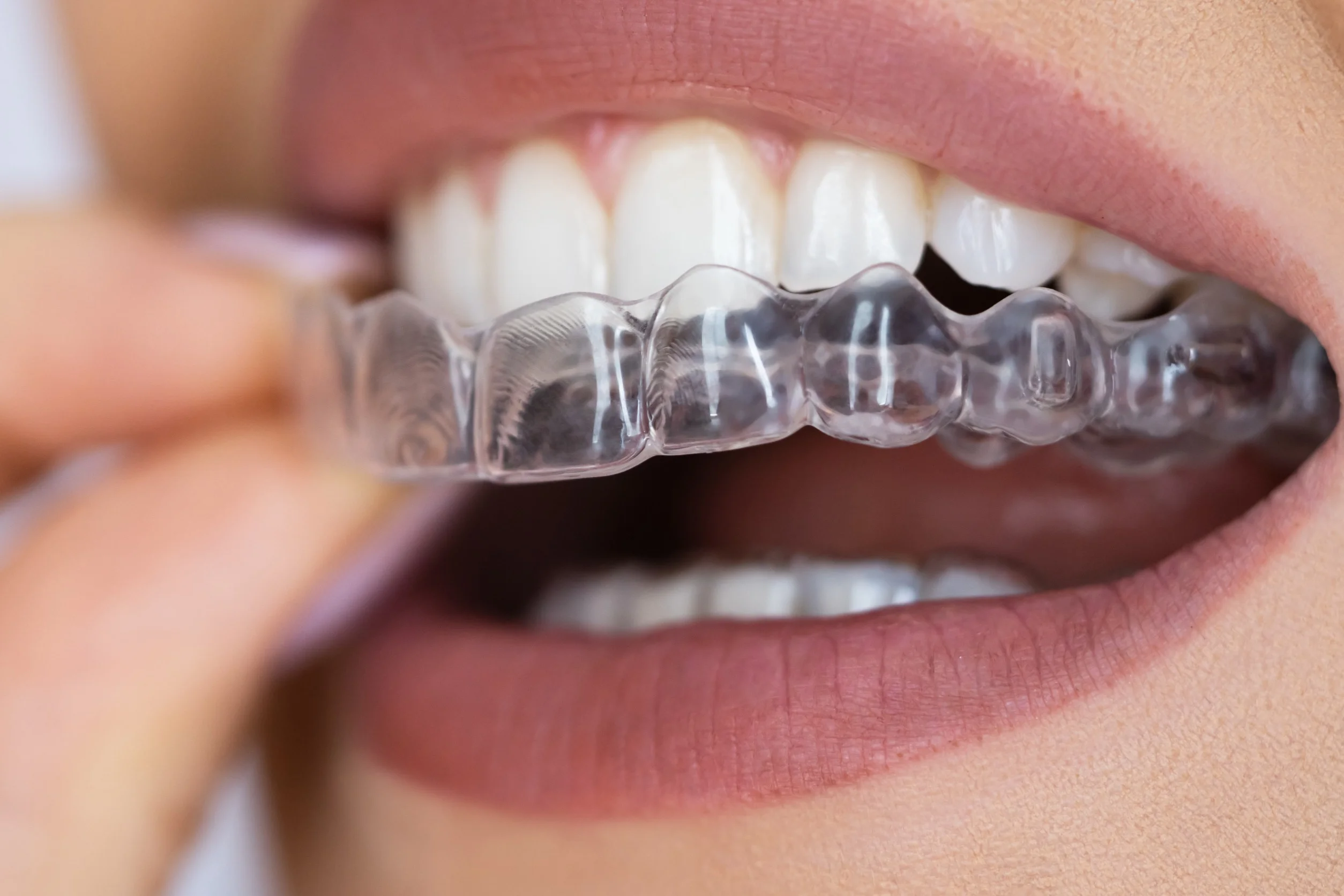 Invisalign | Tooth Works Dentistry