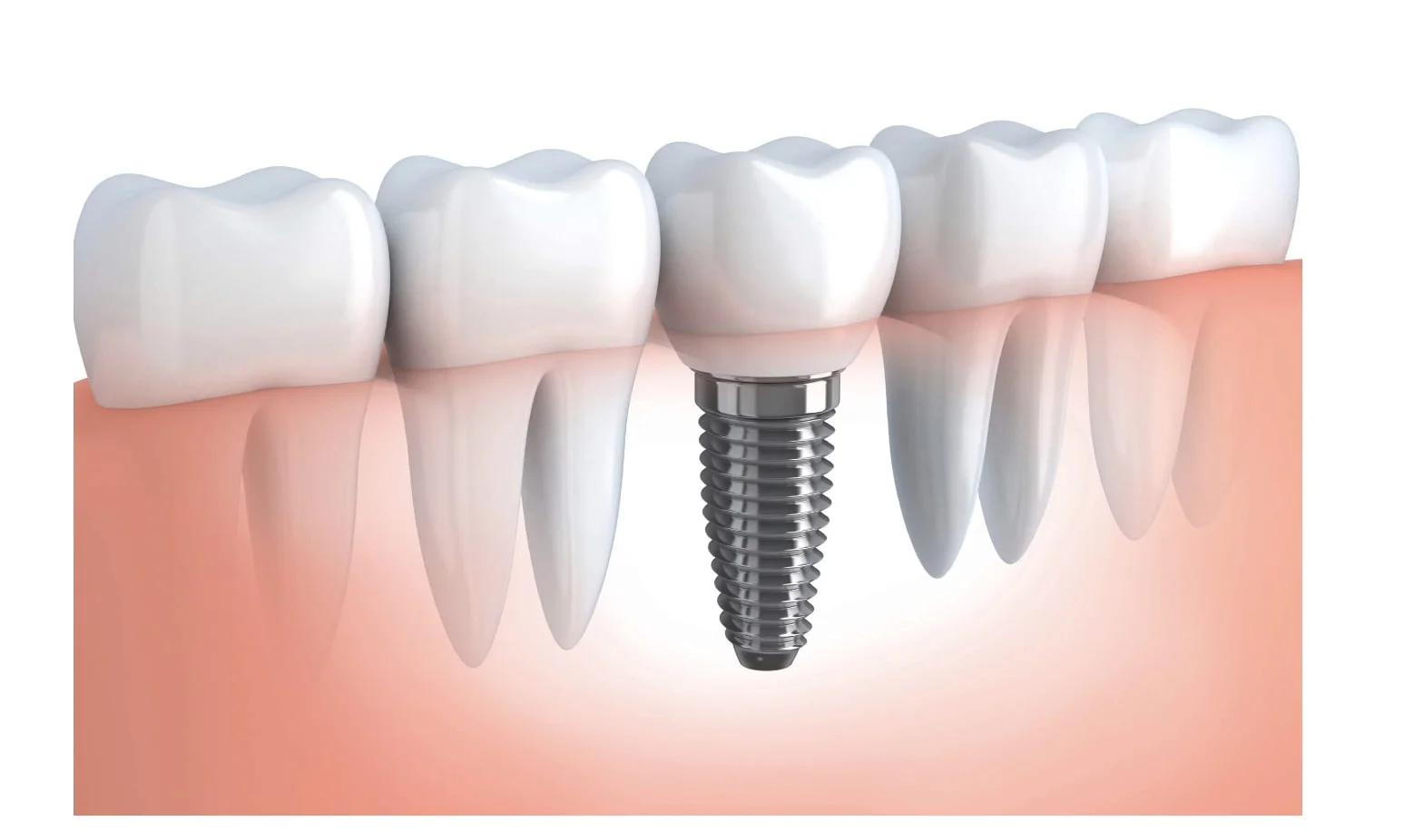 Dental Implants | Tooth Works Dentistry