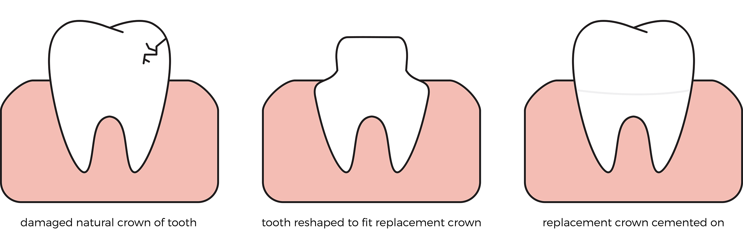 Tooth Works Blog- Crowns-01.png