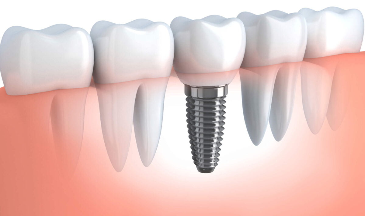 dental-implant-1.jpg
