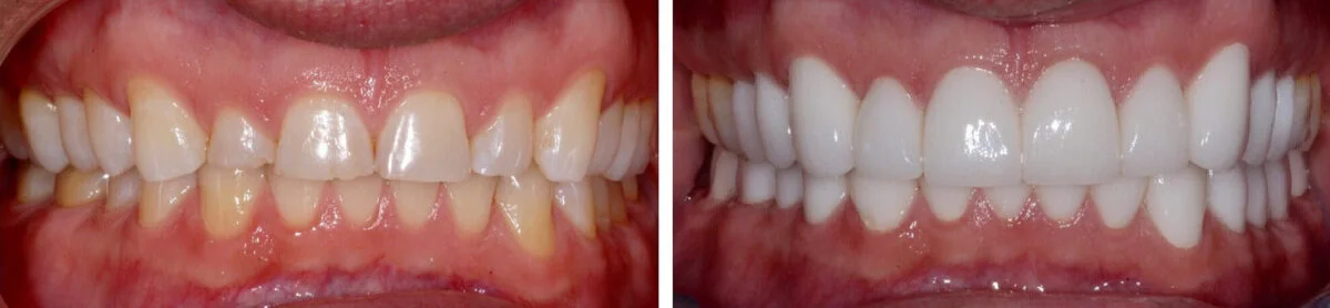 Before and after of veneer placement to resolve age-related extrinsic staining and natural tooth wear.