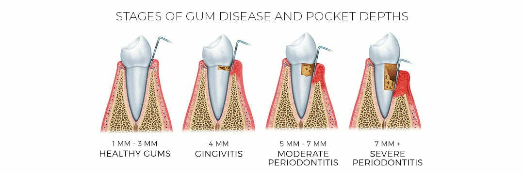 gum_disease_pocket.jpg