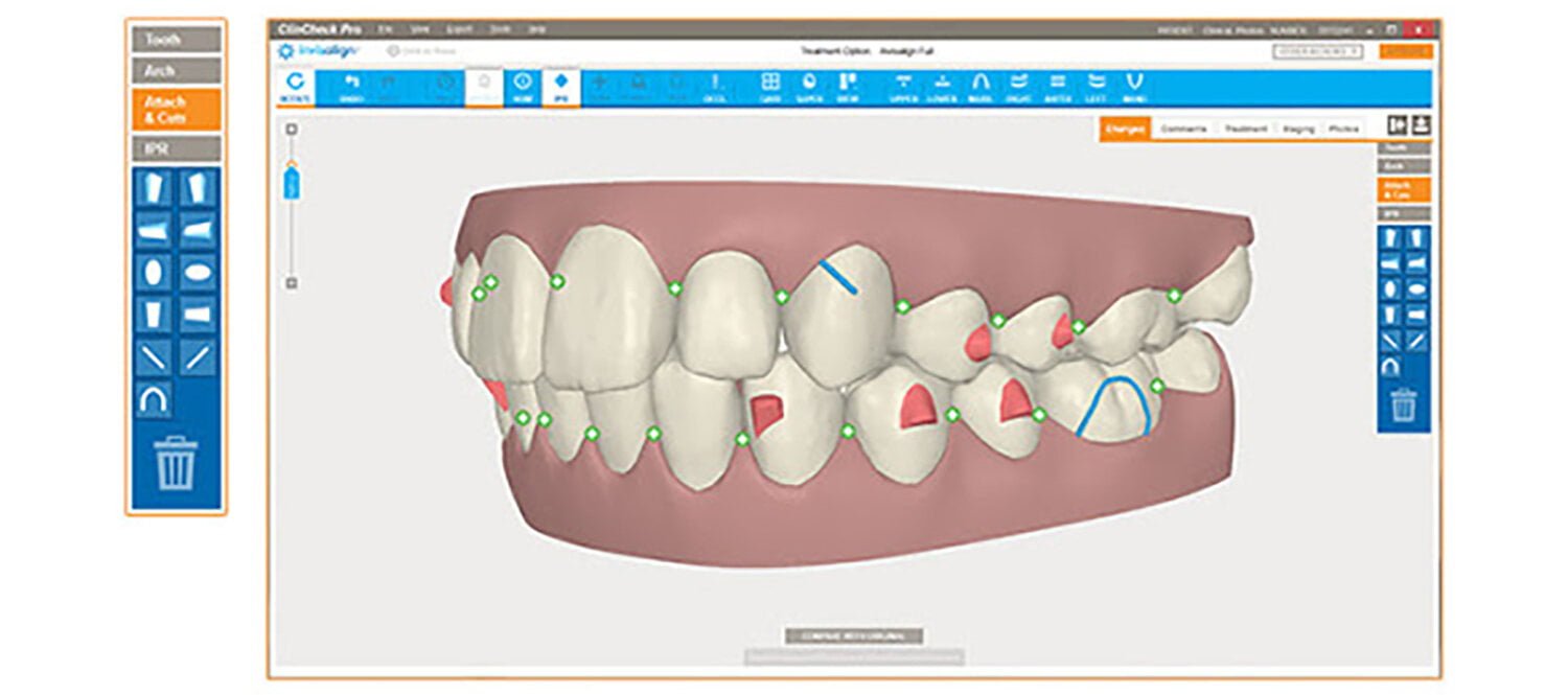 Dr. Withanachchi reviews and adjusts all Invisalign treatment plans, to ensure he and his patient are thrilled with the treatment outcome.