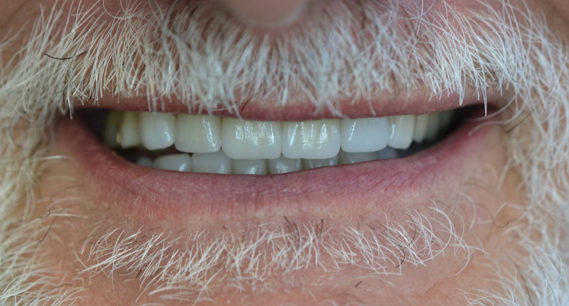 After smile shot